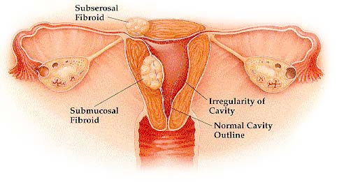 graphic fibroid