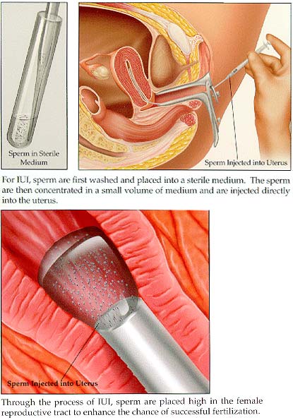 graphic iui