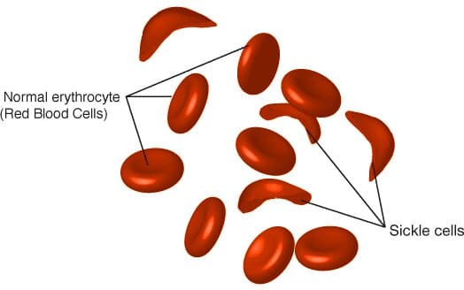 sickle cell anemia 1