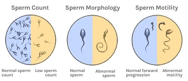 sperm abnormalities