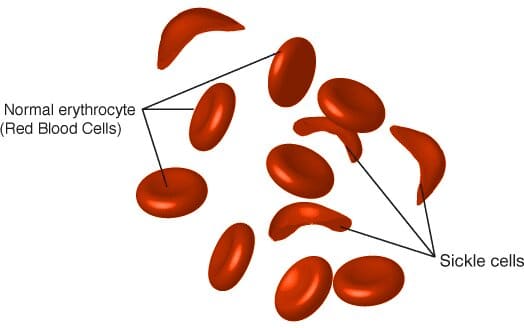 sickle cell anemia 1 sickle cell anemia 1