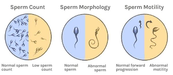 sperm abnormalities sperm abnormalities